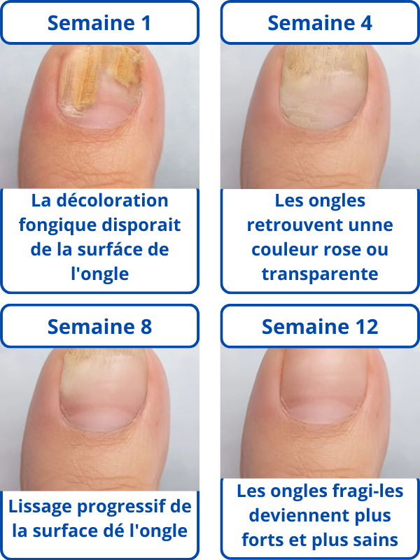 Adesivo Dermatológico para Unhas - DermaNail